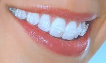 clear-braces-nyc