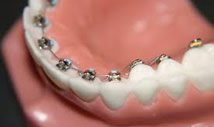 lingual-braces-nyc