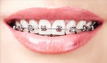 metal-braces-nyc