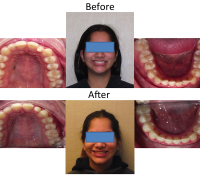 braces-orthodontist-nyc-before-after-1