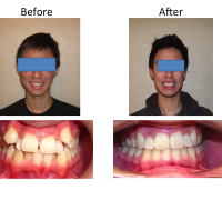 braces-orthodontist-nyc-before-after-10