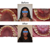 braces-orthodontist-nyc-before-after-11