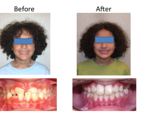 braces-orthodontist-nyc-before-after-12