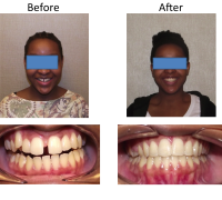braces-orthodontist-nyc-before-after-13