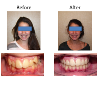 braces-orthodontist-nyc-before-after-14