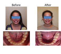 braces-orthodontist-nyc-before-after-15