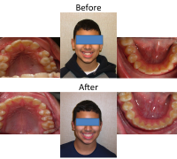 braces-orthodontist-nyc-before-after-16