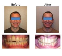 braces-orthodontist-nyc-before-after-17
