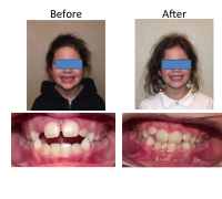 braces-orthodontist-nyc-before-after-18