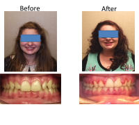 braces-orthodontist-nyc-before-after-19