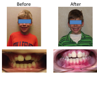 braces-orthodontist-nyc-before-after-2