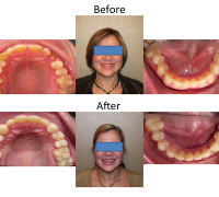braces-orthodontist-nyc-before-after-20
