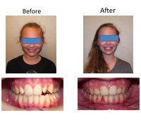 braces-orthodontist-nyc-before-after-21
