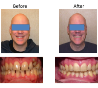 braces-orthodontist-nyc-before-after-22