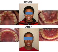 braces-orthodontist-nyc-before-after-23