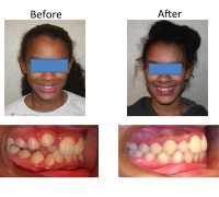 braces-orthodontist-nyc-before-after-24