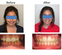 braces-orthodontist-nyc-before-after-25