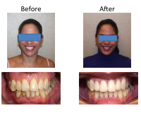 braces-orthodontist-nyc-before-after-26