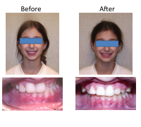 braces-orthodontist-nyc-before-after-27