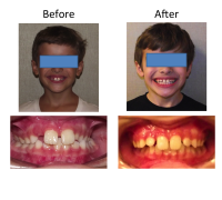 braces-orthodontist-nyc-before-after-28