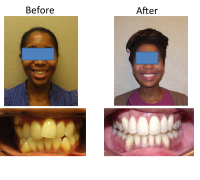 braces-orthodontist-nyc-before-after-29
