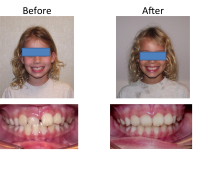 braces-orthodontist-nyc-before-after-3