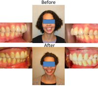 braces-orthodontist-nyc-before-after-30