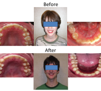 braces-orthodontist-nyc-before-after-31