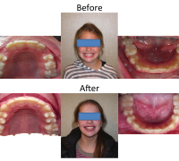 braces-orthodontist-nyc-before-after-32
