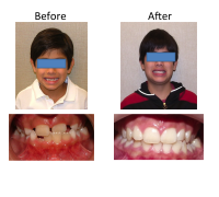 braces-orthodontist-nyc-before-after-33