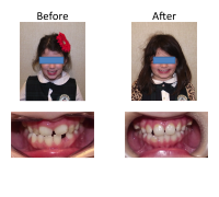 braces-orthodontist-nyc-before-after-34
