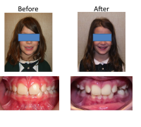 braces-orthodontist-nyc-before-after-35