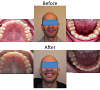 braces-orthodontist-nyc-before-after-36