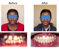 braces-orthodontist-nyc-before-after-37