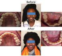 braces-orthodontist-nyc-before-after-38