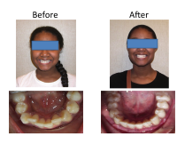 braces-orthodontist-nyc-before-after-39