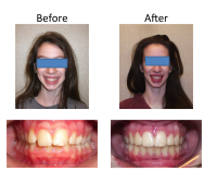 braces-orthodontist-nyc-before-after-4