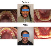 braces-orthodontist-nyc-before-after-40