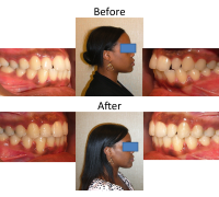 braces-orthodontist-nyc-before-after-41
