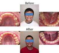 braces-orthodontist-nyc-before-after-42