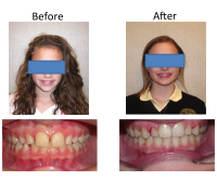 braces-orthodontist-nyc-before-after-43