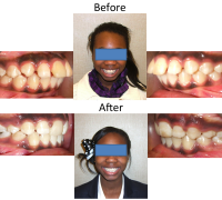 braces-orthodontist-nyc-before-after-44