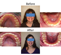 braces-orthodontist-nyc-before-after-45