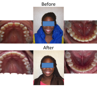 braces-orthodontist-nyc-before-after-46