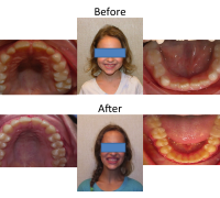 braces-orthodontist-nyc-before-after-47