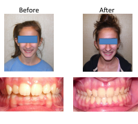 braces-orthodontist-nyc-before-after-48