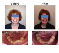 braces-orthodontist-nyc-before-after-49