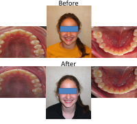 braces-orthodontist-nyc-before-after-5