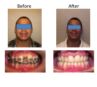 braces-orthodontist-nyc-before-after-50