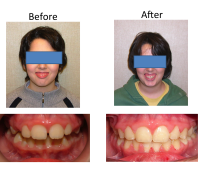 braces-orthodontist-nyc-before-after-51